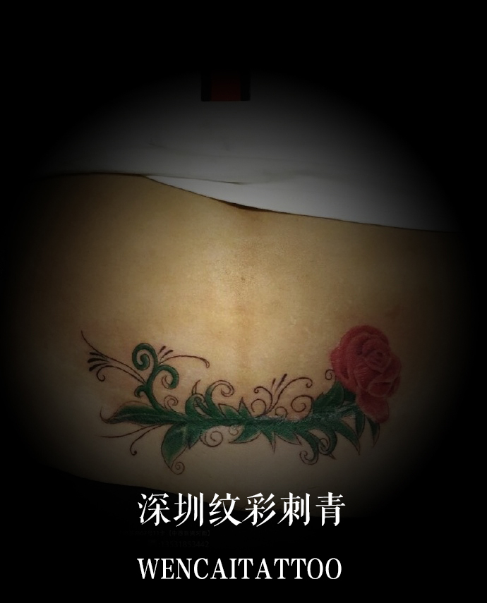 伟大的妈妈王女士腹部破腹产疤痕遮盖